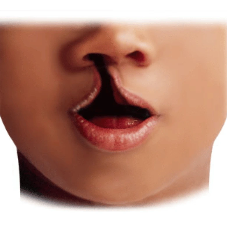 Cleft Lip and Palate image