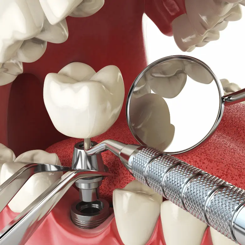 Graphic showing the installation of Dental Implants