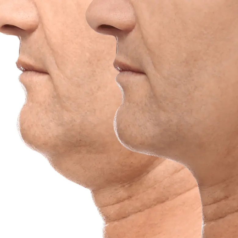 mage showing patient with a before and after Orthognathic Surgery