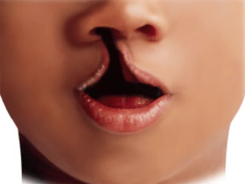 Cleft Lip and Palate image