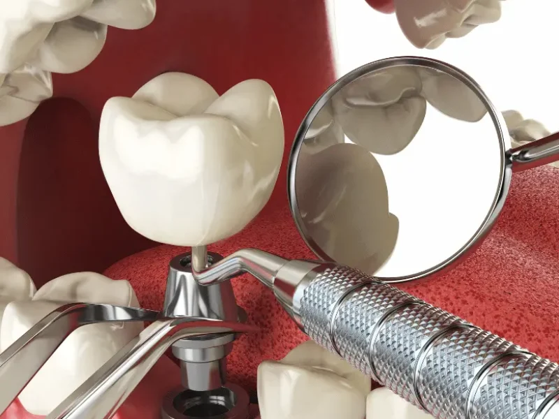 Graphic showing the installation of Dental Implants