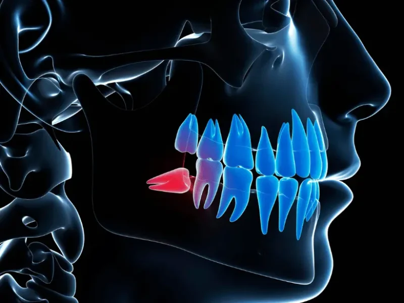 Graphic showing position of impacted tooth